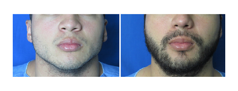 TONICO CRECIMIENTO CAPILAR-FOLICULAR-ORGANICO 30 ml REGISTRO SANITARIO: CS-CR-25-02966